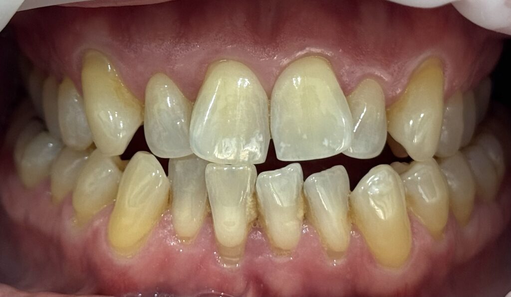 affordable veneers near Caringbah