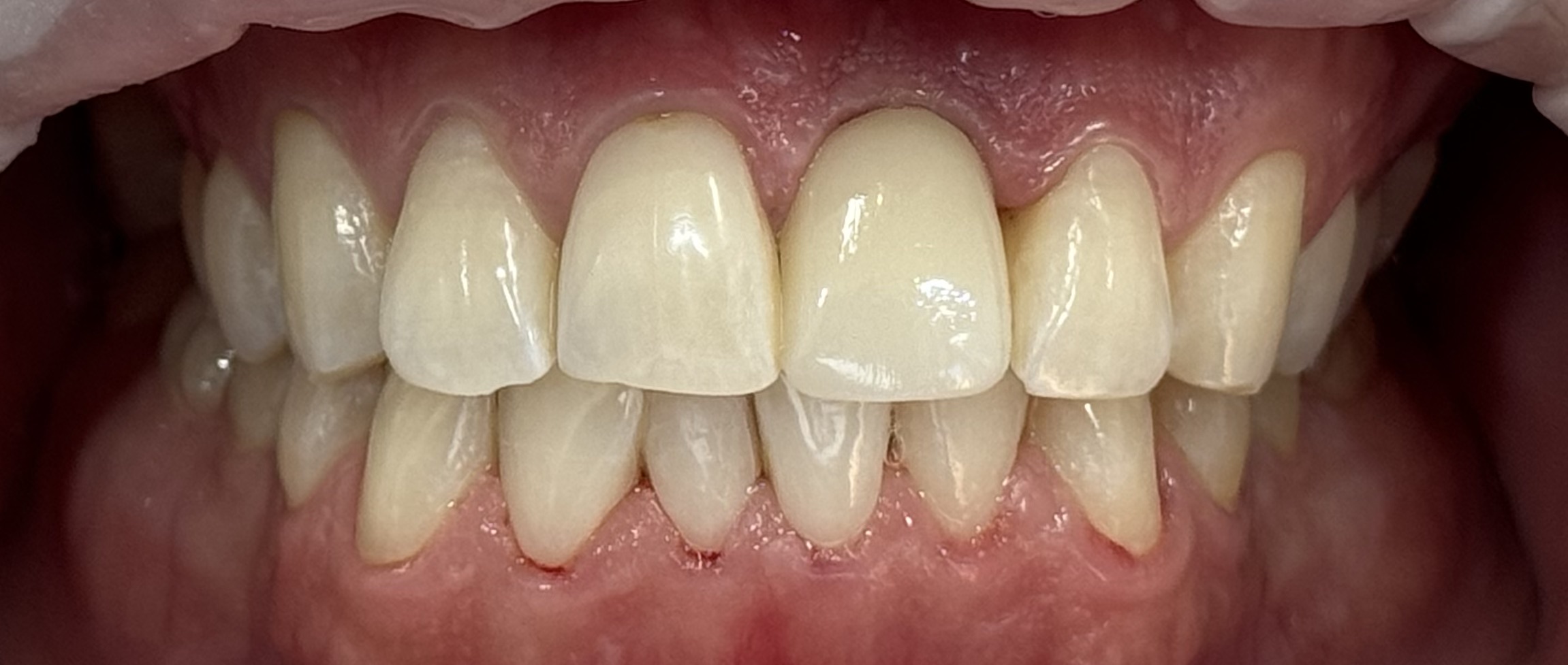 Dental Implant 1 (After)