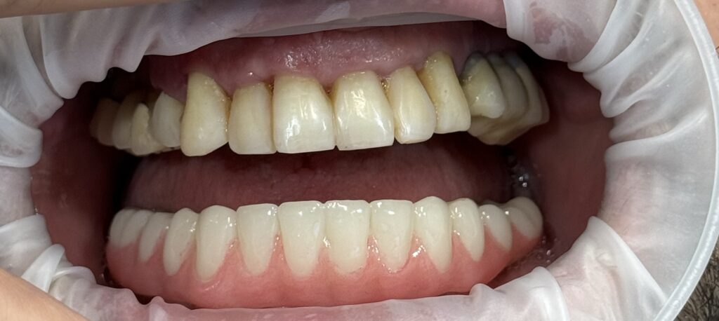 all on 4 dental implants in sutherland shire