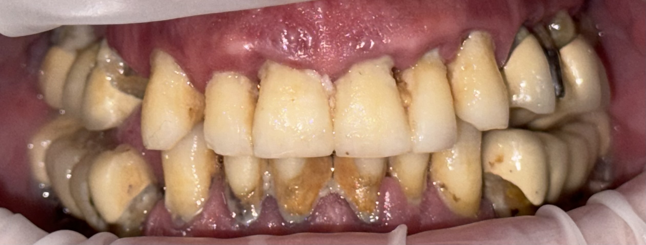 Dental Implants 3 (Before) Dental Implants 3 (Before)