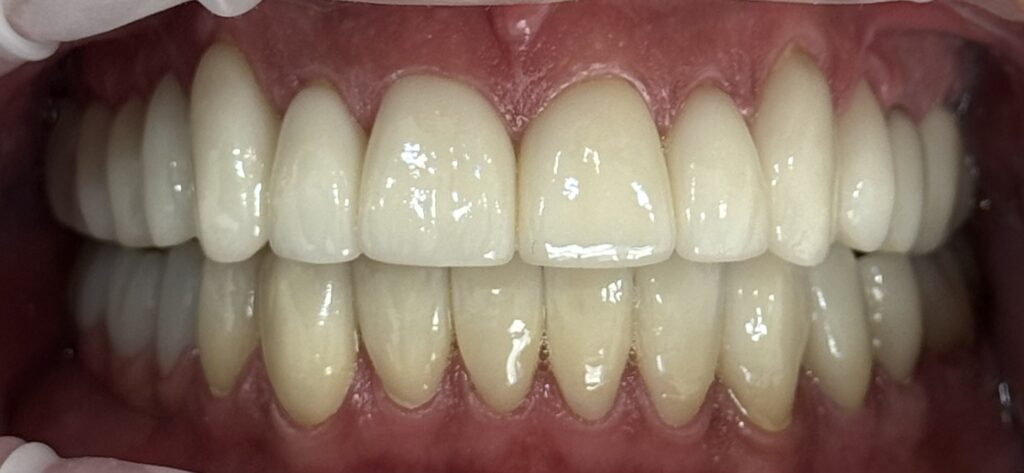 suitability of bonding for cosmetics