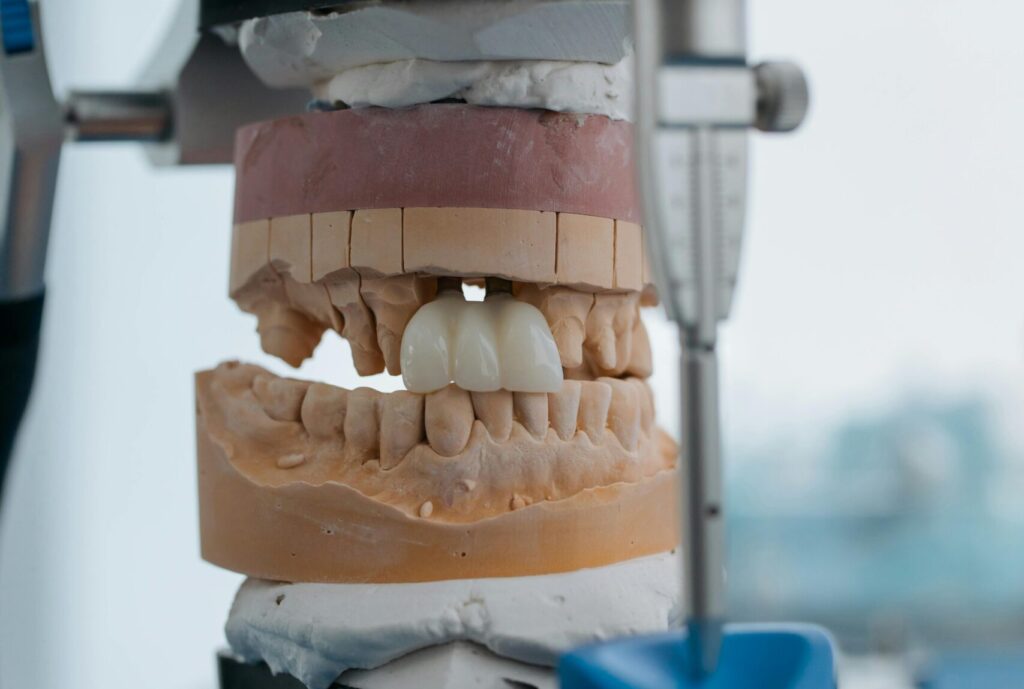 Porcelain veneer teeth