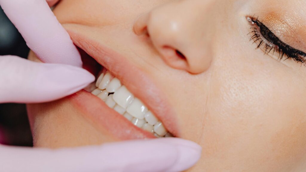 Porcelain veneer treatment in sutherland shire